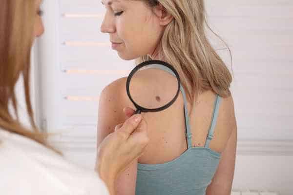 What Are Traditional Skin Lesion Removal Methods sc?