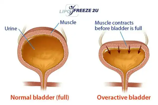 diagram of overactive bladder treatment sc