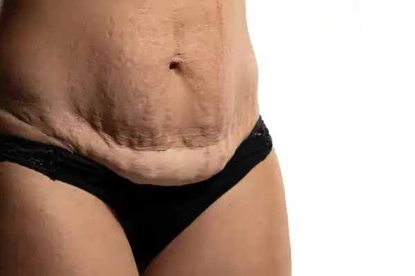 loose skin after weight loss injections sc