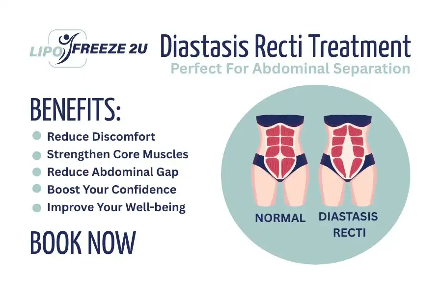 Benefits of body toning treatment sc for Diastasis recti