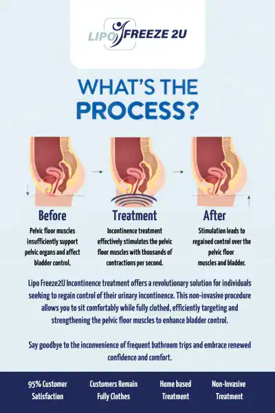 Diagram of how incontinence treatment sc works.