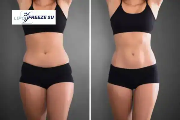 How Can LIPO FREEZE 2U Support Your Post-Pregnancy Body Recovery sc?