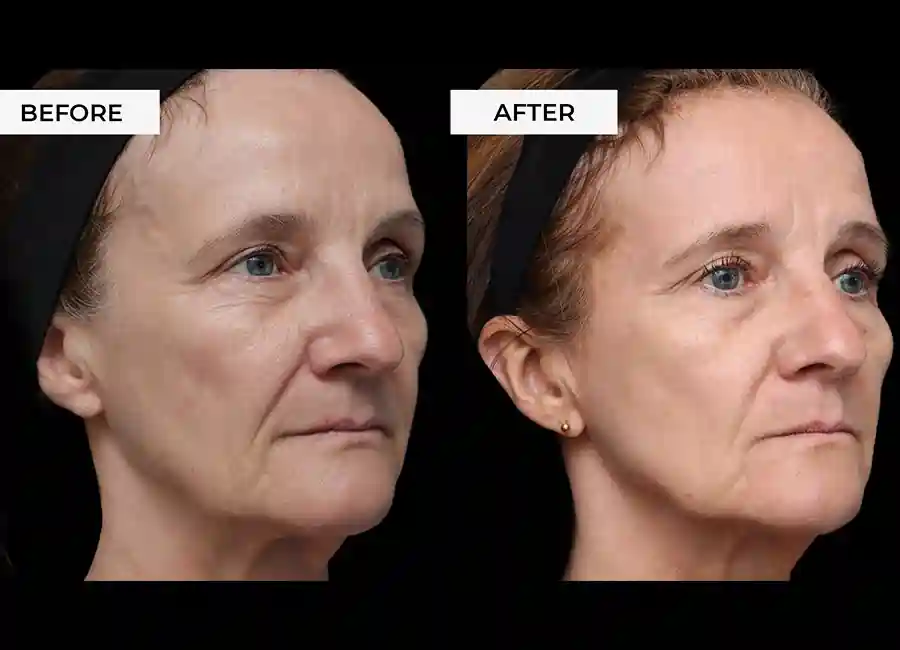 How Many RF Microneedling Sessions Will You Need to See a Difference sc?