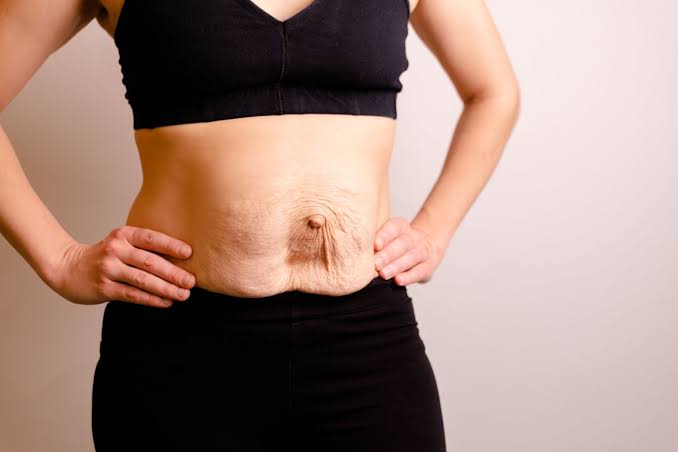 Is Surgery Really the Only Way to Repair Diastasis Recti sc?
