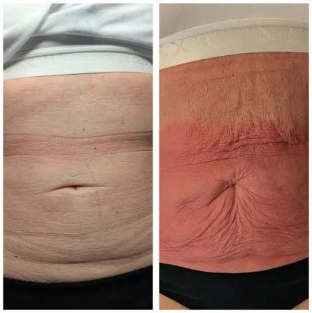 How Does RF Microneedling Improve Crepey, Thin and Uneven Skin Texture sc?