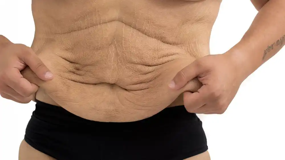 RF Microneedling for Loose Skin: How Can It Help Tighten and Reshape the Skin sc?